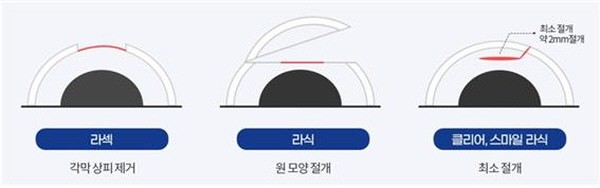 (사진=잠실삼성안과 제공)