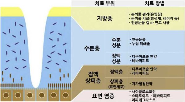 안구건조증의 다양한 원인에 따른 맞춤 치료 방법